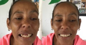 Before and after teeth denture